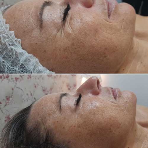 tratamiento bellactionduo facial lovely beautee centro estetico malaga